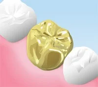 白金加金(FMC)のクラウン
