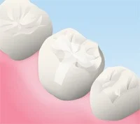 セラミックのインレー