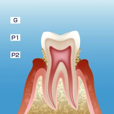 STEP2 軽度