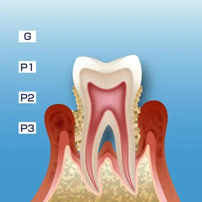 STEP3 中等度