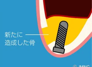 サイナスリフト