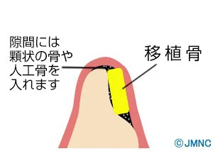 骨移植