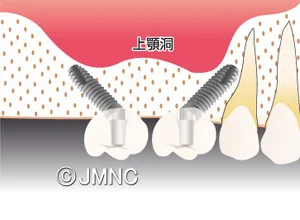 傾斜埋入