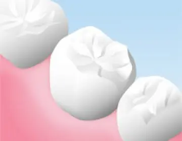 オールセラミックのかぶせ物
