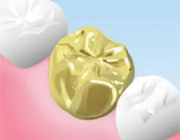 白金加金（FMC）のかぶせ物