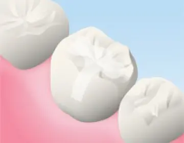 セラミックの詰め物