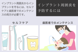 インプラントは適切なメンテナンスが必要不可欠です