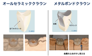 人工歯の素材の特徴について解説します