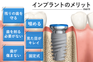 インプラントのメリットを詳しく知りたい！