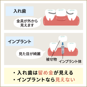 入れ歯とインプラントのちがい、義歯の選択肢とは